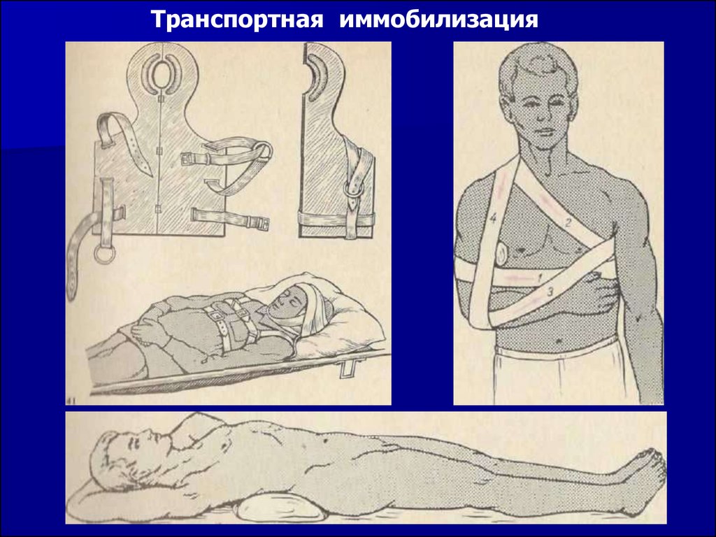 Физическая иммобилизация. Транспортная иммобилизация. Стенд транспортная иммобилизация. Транспортная иммобилизация иллюстрация. Травмы опорно-двигательного аппарата иммобилизация.