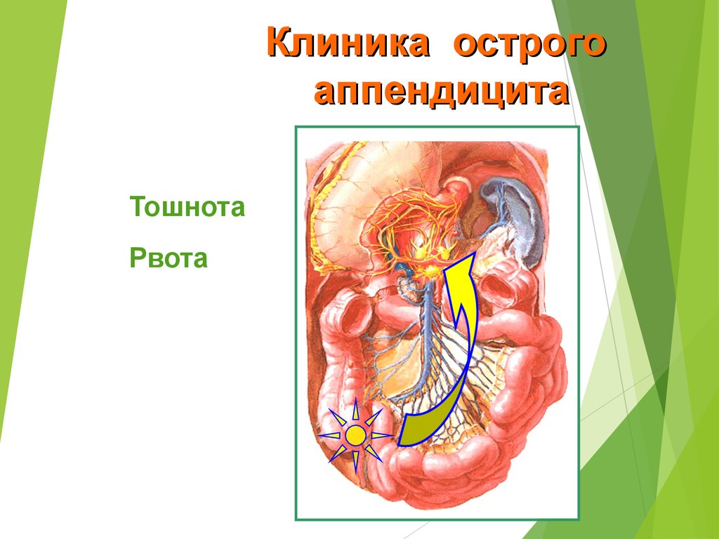 Острый аппендицит презентация. Внутреннее строение человека аппендицит.