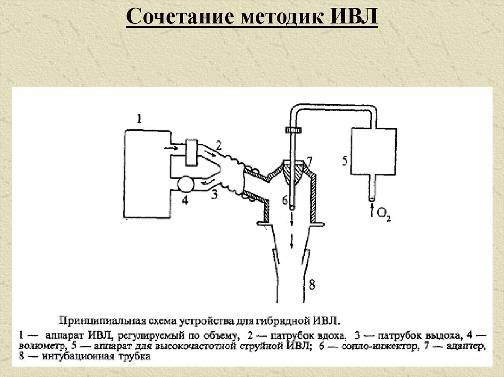 Схема работы ивл