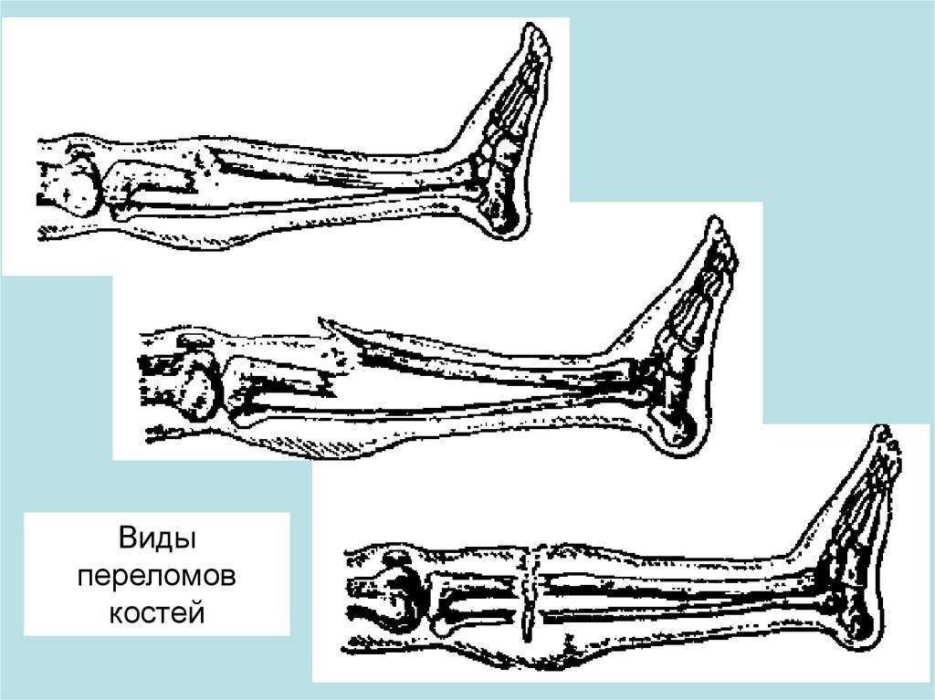 Открытый и закрытый перелом. Степени переломов костей.