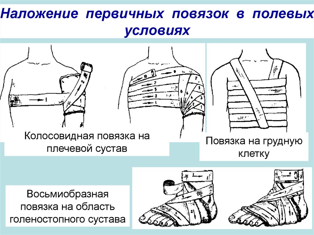 Порядок наложения повязки при ранениях головы туловища верхних и нижних конечностей презентация