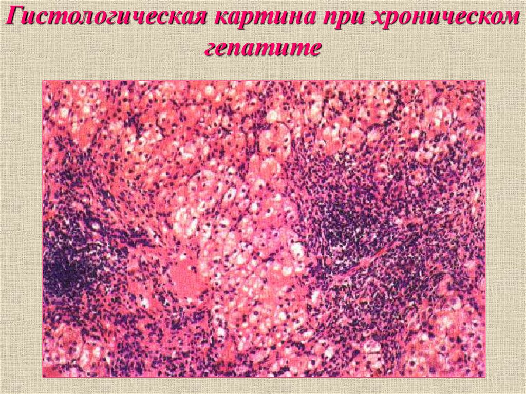 Хроническое заболевание гепатит