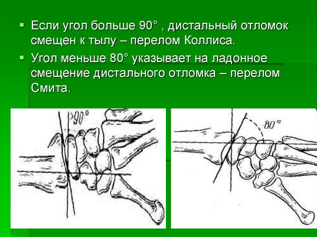 Повреждение кисти травматология презентация