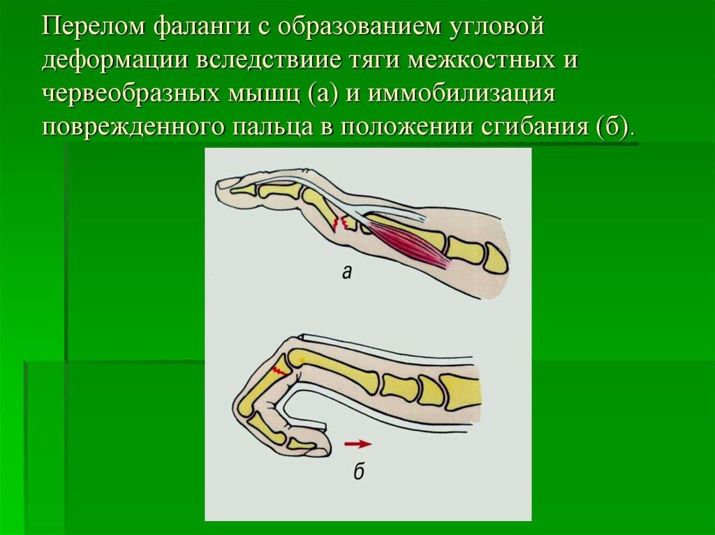 Переломы кисти травматология презентация