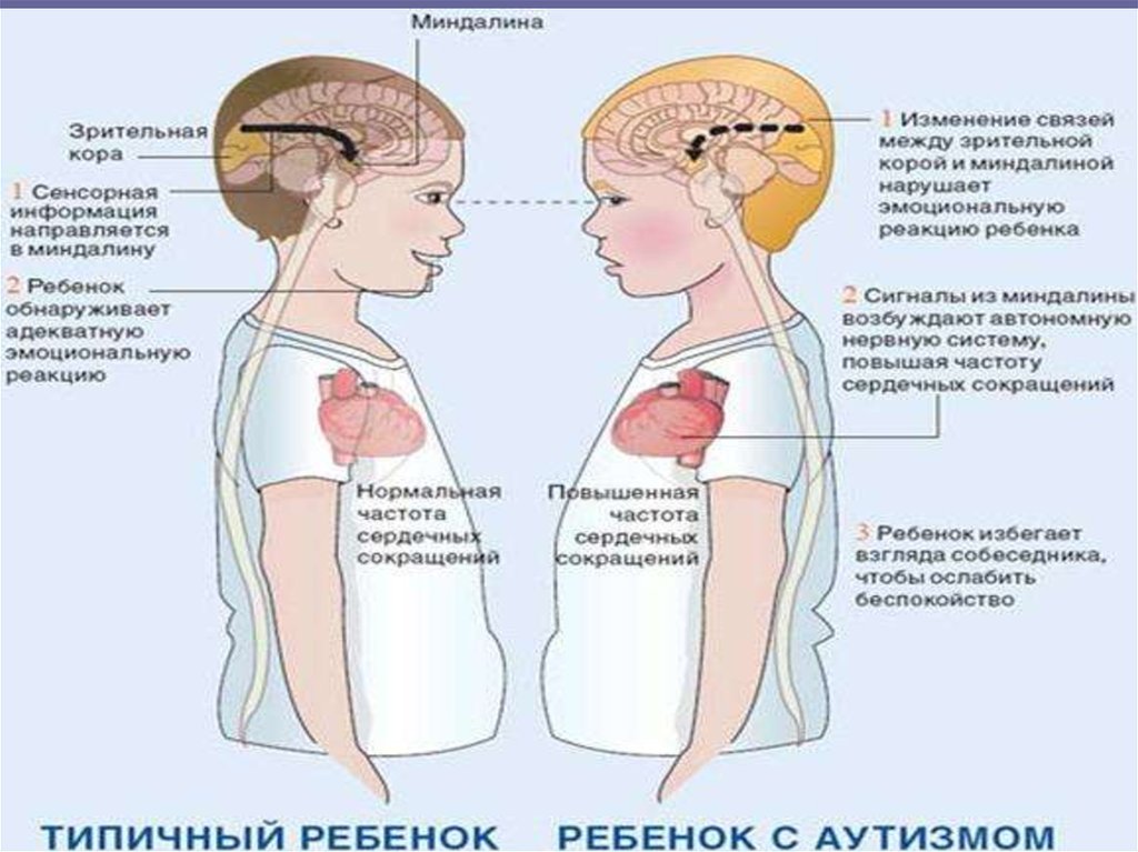 Крылышки у аутистов. Аутизм. Аутизм у детей. Болезнь аутизм у детей. Легкая форма аутизма у взрослых.