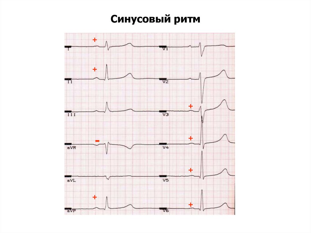 Что значит синусовый ритм сердца на экг. Электрокардиограмма показатели синусовый ритм. Норма ЭКГ синусный ритм. Синусовый ритм на ЭКГ норма. Кардиограмма сердца расшифровка синусовый ритм норма.