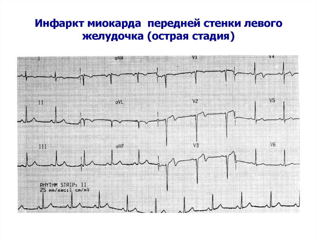 Очаговые изменения левого желудочка. ОИМ правого желудочка на ЭКГ. Передний инфаркт миокарда на ЭКГ перегородки. ЭКГ при трансмуральном инфаркте миокарда острейшая фаза. ЭКГ передне перегородочный инфаркт миокарда левого желудочка.