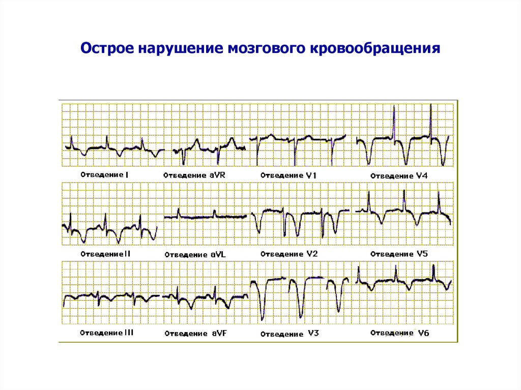Кардиограмма при инсульте фото