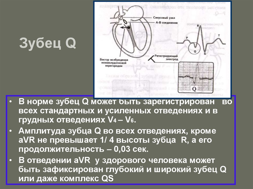 Изменение зубца q. Зубец q на ЭКГ В норме. Зубец q в грудных отведениях норма. Зубец q в v1 в норме. Зубец q в 1 отведении ЭКГ.