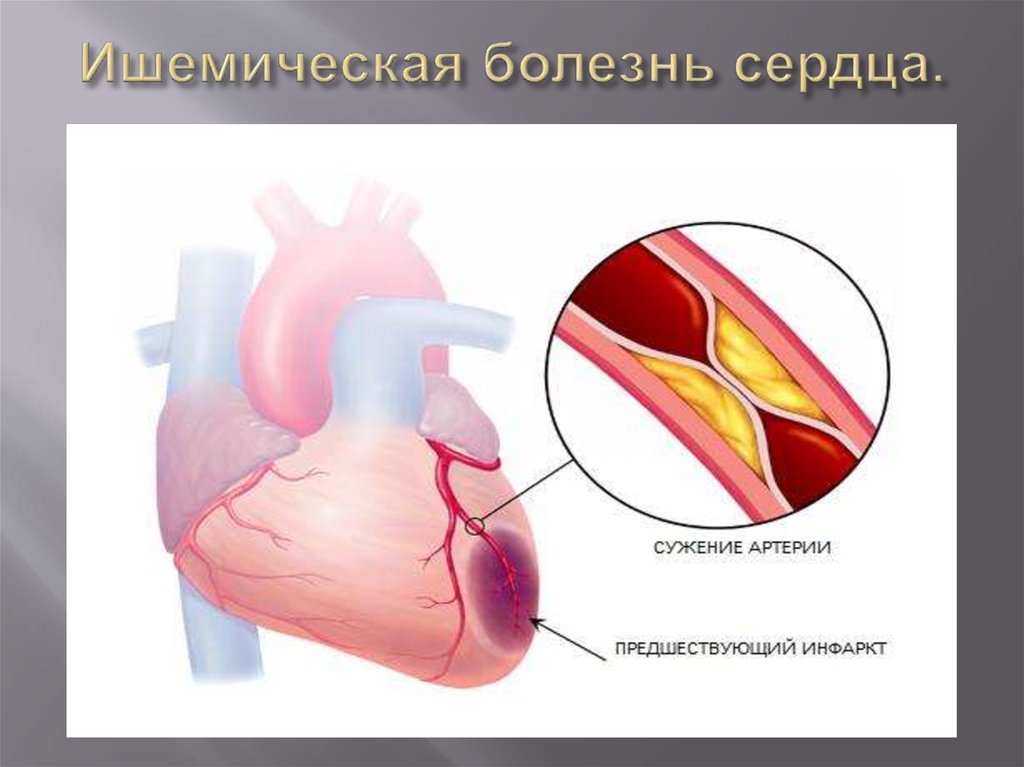 Ишемия передней стенки. Ишемическая болезнь сердца. Ишемия инфаркт миокарда.