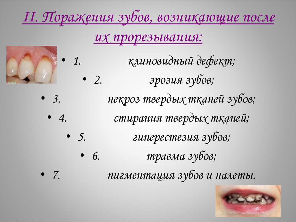 II. Поражения зубов, возникающие после их прорезывания: