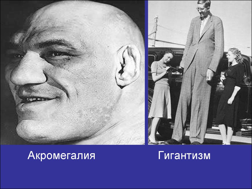 Акромегалия карликовость. Акромегалия и гипофизарный гигантизм. Акромегалия акромегалия. Гигантизм болезнь акромегалия. Акромигалический Гианти ЗМ.