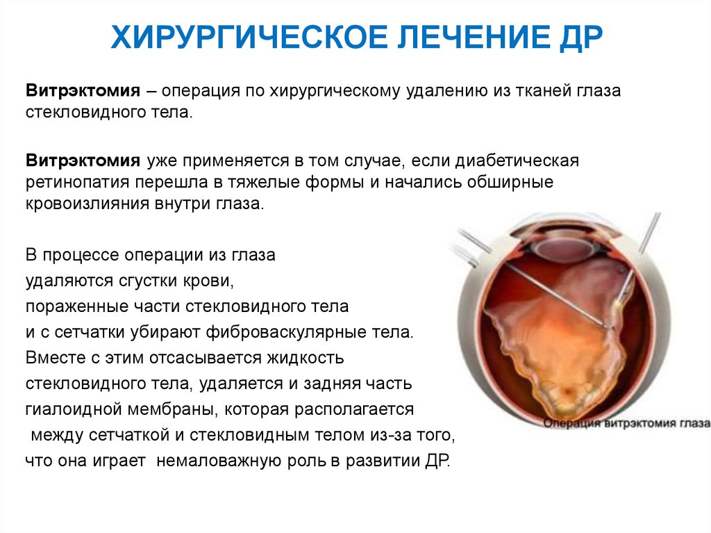 Стекловидное тело операция. Витрэктомия при диабетической ретинопатии. Диабетическая ретинопатия глаз. Микроинвазивная витрэктомия.