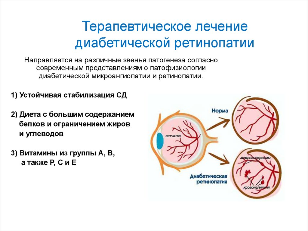 Диабетическая ретинопатия презентация офтальмология - 83 фото