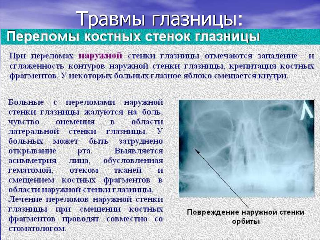 Повреждение стенок. Перелом глазной орбиты. Перелом стенки глазницы.