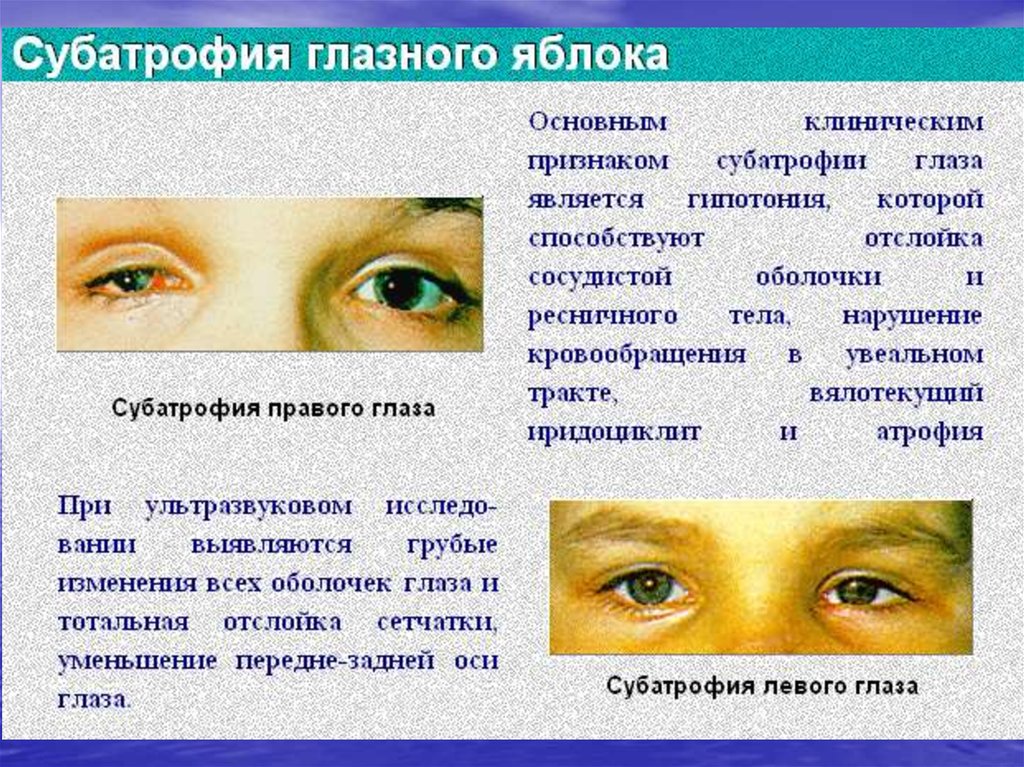 Почему уменьшился глаз. Субатрофия глазного яблока. Повреждения органа зрения. Гипотония глазного яблока.