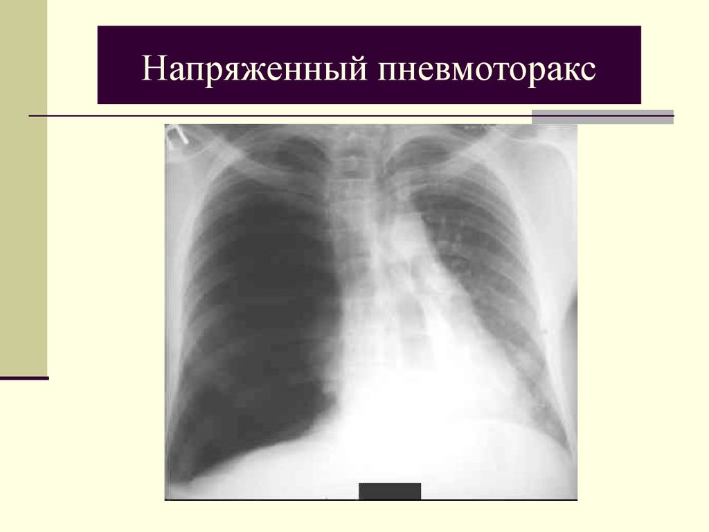 Напряженный пневмоторакс помощь