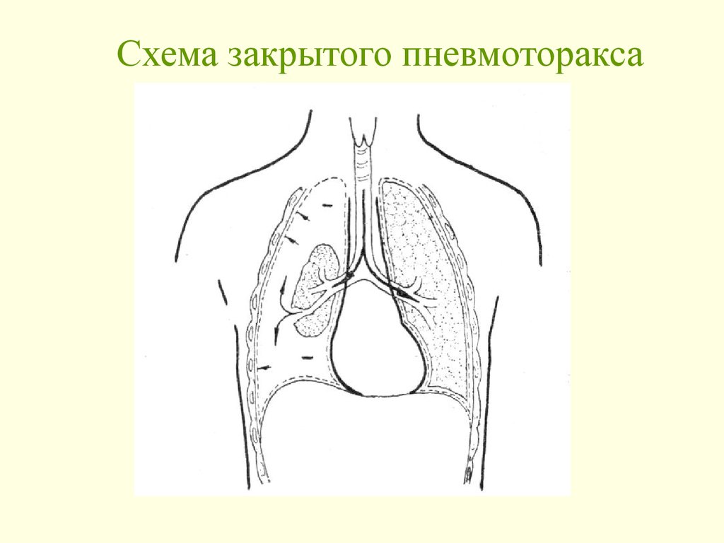 Схема закрытого пневмоторакса