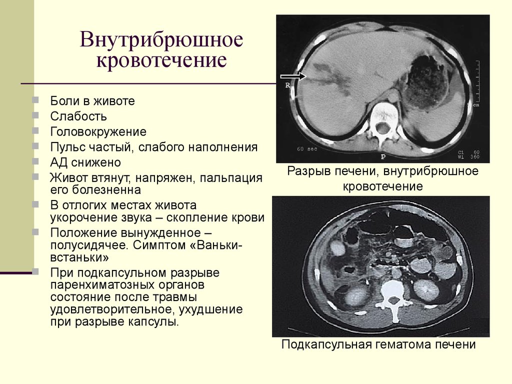 Внутреннее кровотечение клиническая картина