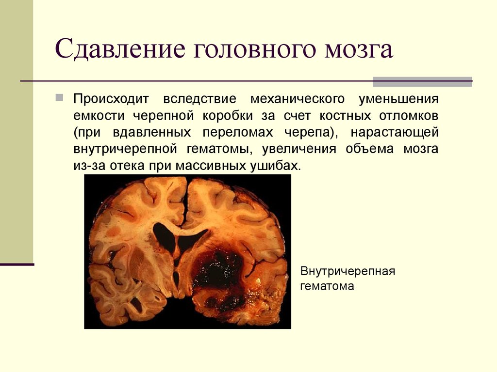 Сдавление головного мозга