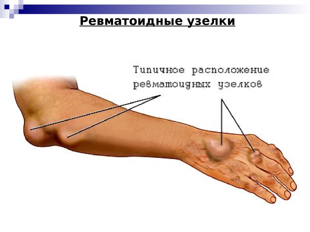 Симптомы ревматизма. Ревматоидный артрит ревматоидные узелки. Ревматоидный артрит локтевого сустава.