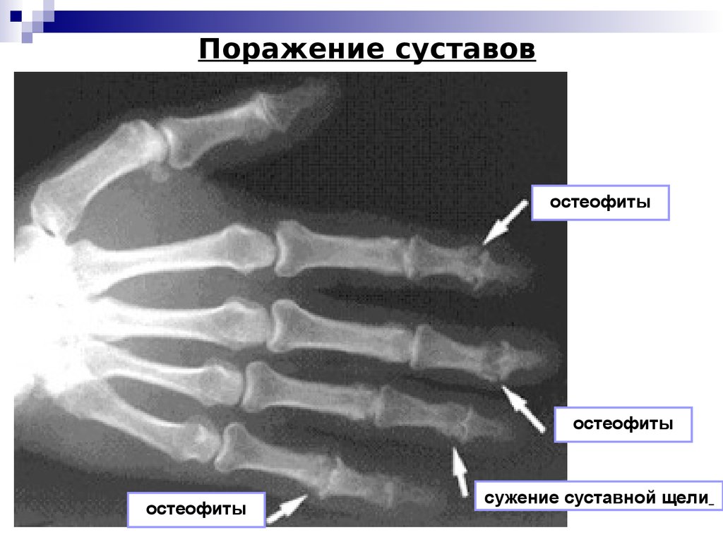 Остеопороз стопы. Ревматоидный артрит кисти рентген. Ревматоидный артрит кистей рук рентген. Рентген кистей при ревматоидном артрите. Остеоартроз кистей рентген.