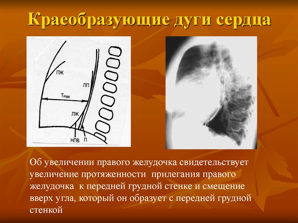 Увеличение правого. Рентген анатомия сердца дуги. Дуги сердца на рентгенограмме норме. Дуги сердца на рентгене. Рентгеноанатомия сердца и крупных сосудов в норме.