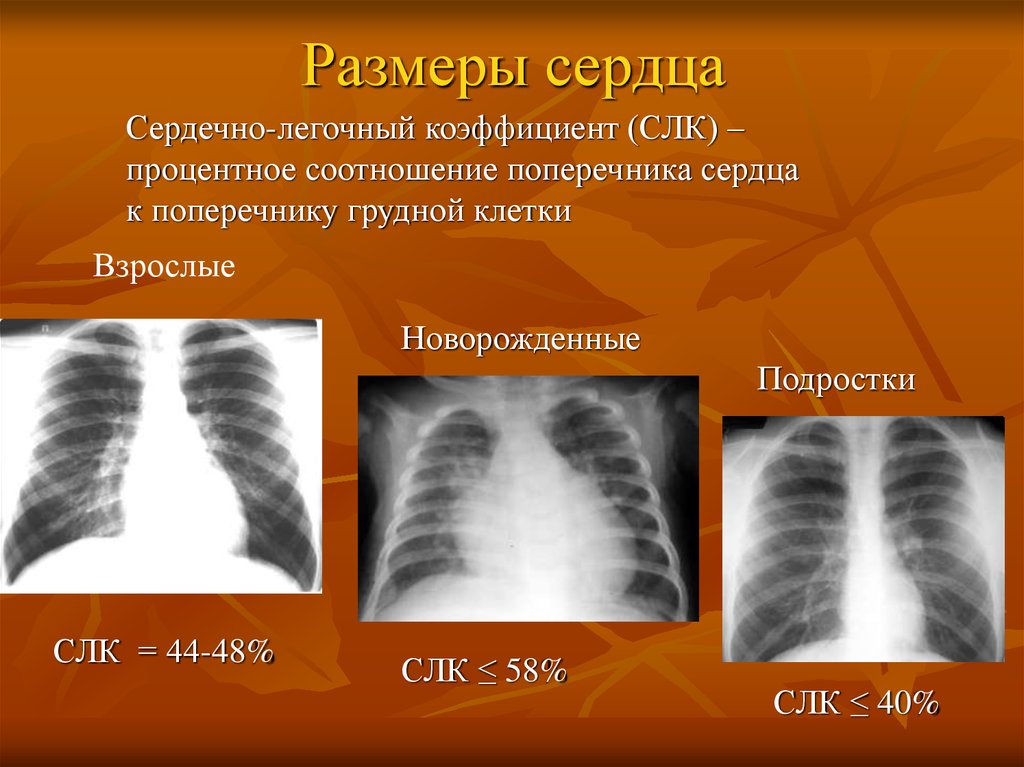 Размеры сердца. Сердечно-легочный коэффициент. Сердечно-легочный коэффициент в норме:. Поперечник сердца на рентгенограмме.