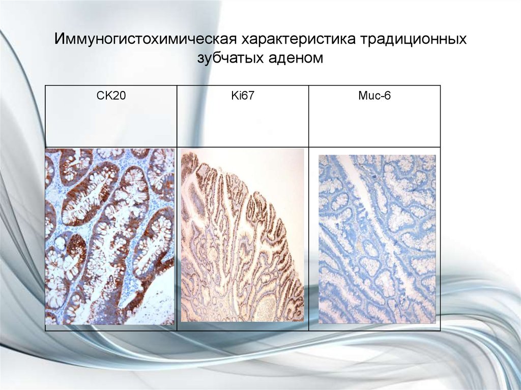 Иммуногистохимическая характеристика традиционных зубчатых аденом