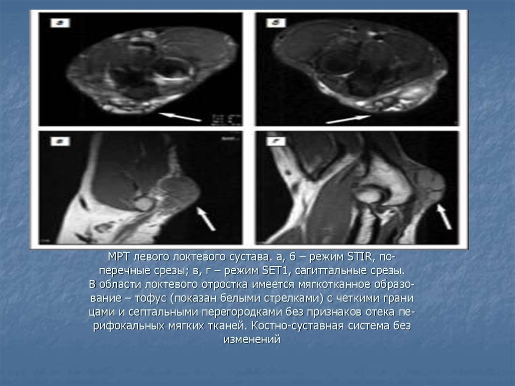 Мрт локтя. Тофусы коленных суставов на мрт. Артроз локтевого сустава мрт.