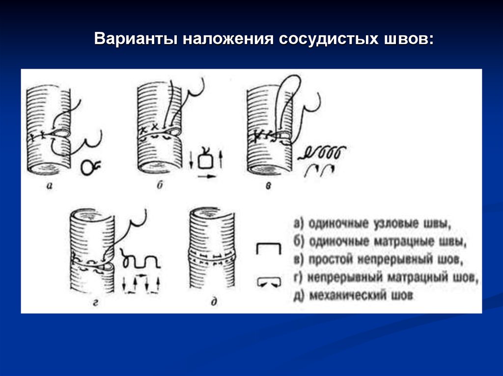 Бесшовное соединение сосудов метод а г коневского. Наложение сосудистого шва. Матрацный сосудистый шов. Механический сосудистый шов.