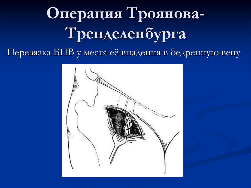 Перевязка подкожных вен. Операция по Троянову-тренделенбургу. Операция Троянова-Тренделенбурга заключается. Кроссэктомия Троянова Тренделенбурга.