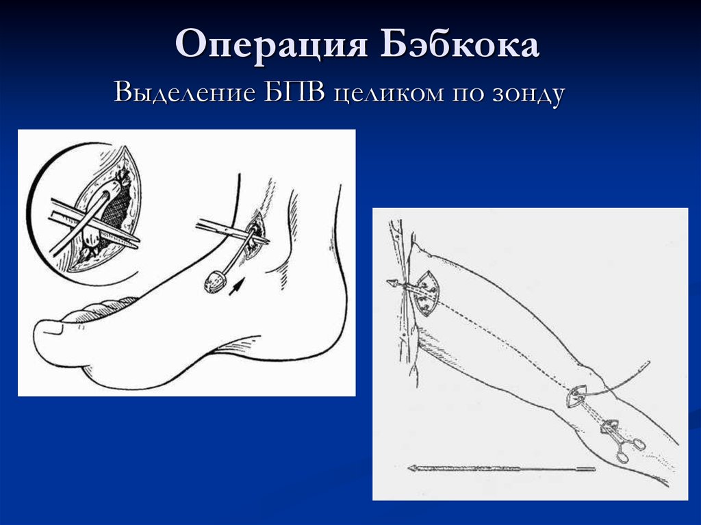 Перевязка подкожных вен