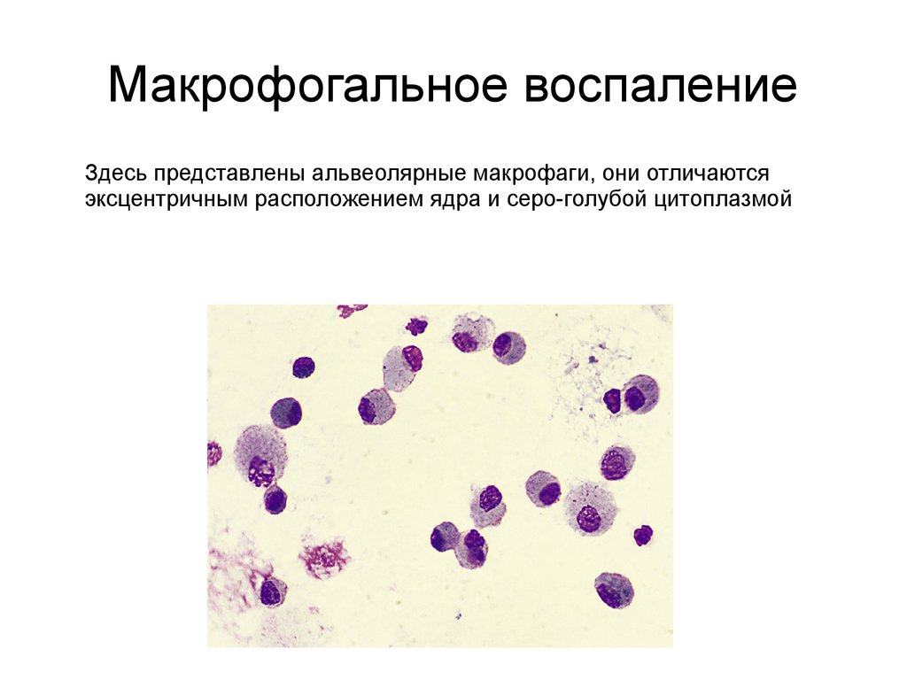 Бронхоальвеолярный рак презентация