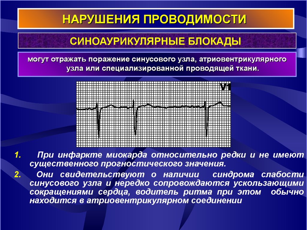 Нарушение синусового. Нарушение проводимости миокарда. Нарушение проводимости блокады. Нарушение проводимости АВ блокады. Нарушение атриовентрикулярной проводимости.