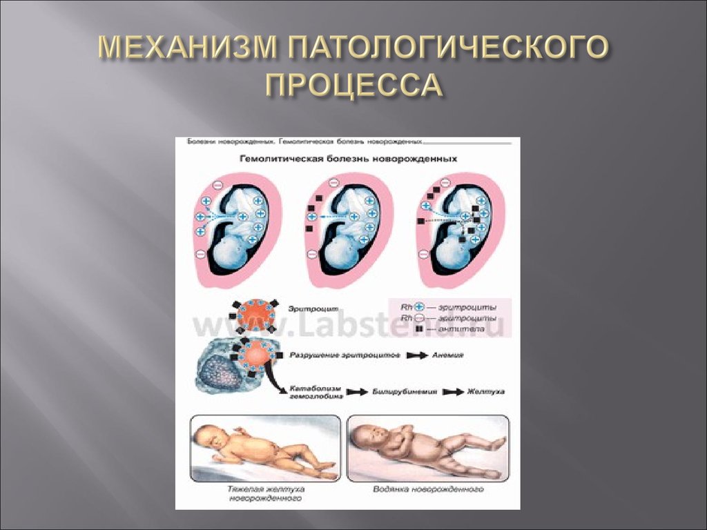 Гемолитическая болезнь новорожденных. Механизм развития гемолитической болезни новорожденных. Схема развития ГБН. Гемолитическая болезнь новорожденных схема. Гемолитическая болезнь схема.