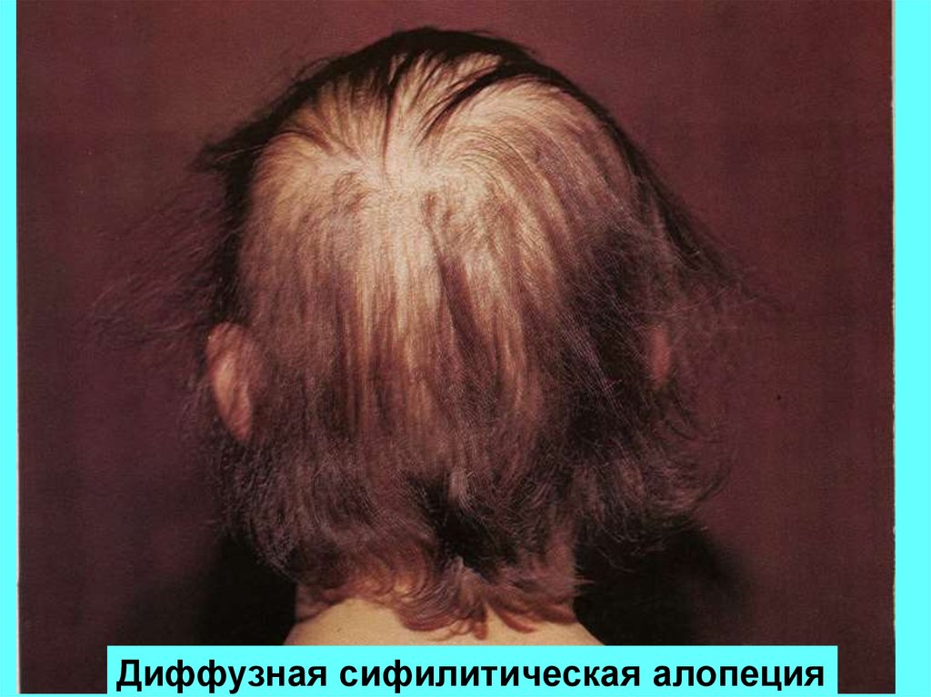 Выпадение волос при истощении организма