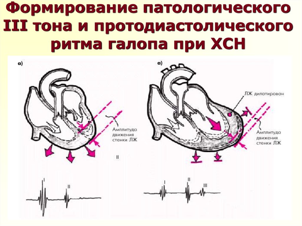 Схема ритма галопа