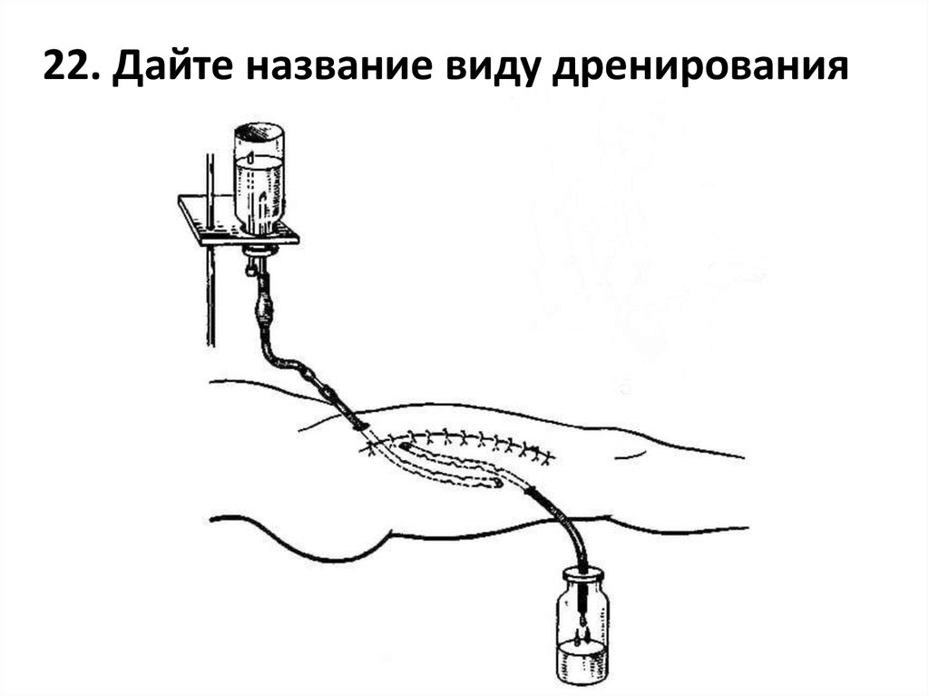 Картинки дренирование раны