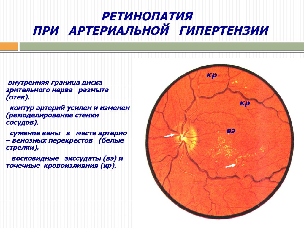 Падение сосудистого тонуса. Нарушения сосудистого тонуса патофизиология. Ремоделирование сосудов при артериальной гипертензии. Ремоделирование сердца и сосудов при ГБ.