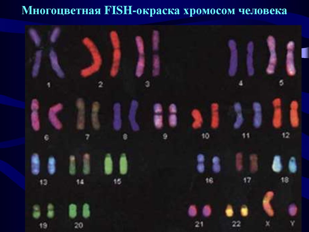 Хромосомы лучше видны. Кариотип методом дифференциальной окраски хромосом. Цитогенетический метод окрашивание хромосом. Кариотипирование хромосом человека. Цитогенетический метод кариотип человека.