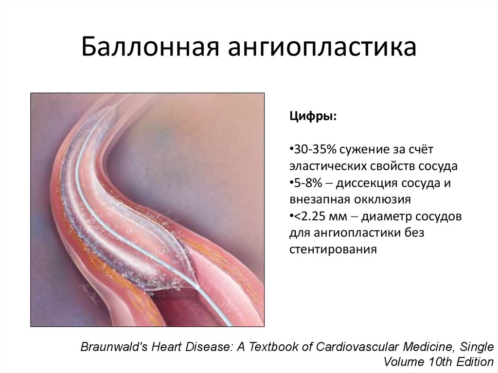 Чрескожная ангиопластика