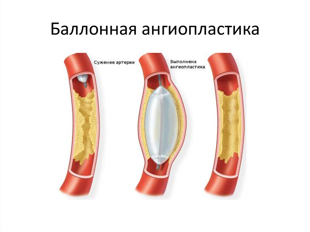 Баллонная ангиопластика нижних конечностей