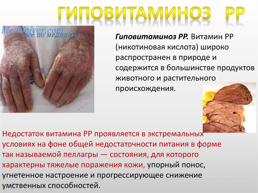 Гиповитаминозы - online presentation