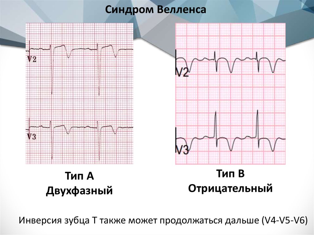 Синдром велленса