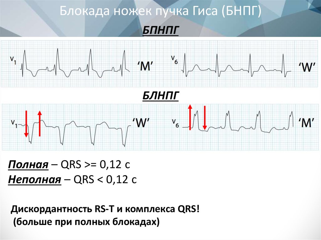 Qrs на экг. Блокада правой ножки пучка Гиса клиника. Блокада ножки пучка Гиса на ЭКГ. Левая блокада пучка Гиса на ЭКГ. Блокада правой ножки Гиса на ЭКГ.