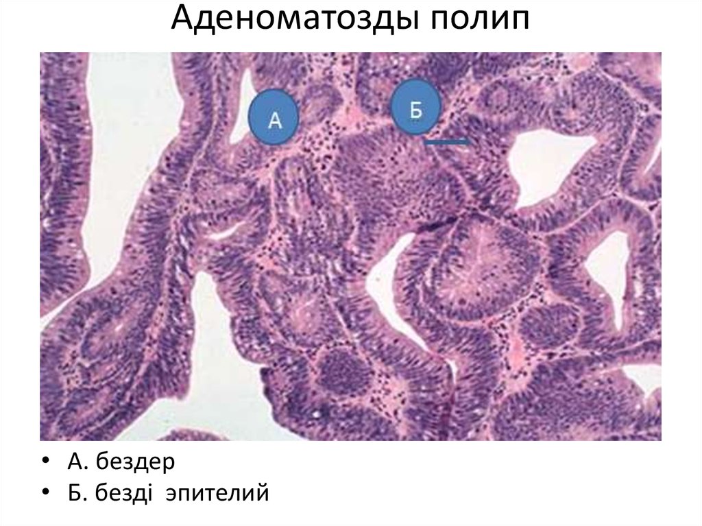 Аденоматозные полипы гистология. Аденоматозный полип матки гистология. Аденоматозные полипы эндометрия гистология. Аденоматозный полип толстой кишки гистология.