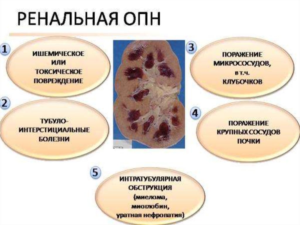 Опп на фоне хбп формулировка диагноза