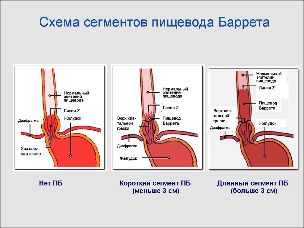 Гимнастика сфинктера. Гастроэзофагеальная-рефлюксная болезнь ФГДС. Классификация пищевода Барретта эндоскопия. Пищеводно кардиальный сфинктер.