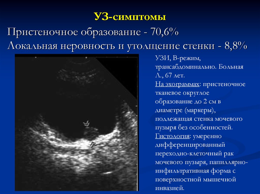 Ультразвуковая картина доброкачественных опухолей молочной железы тесты нмо ответы